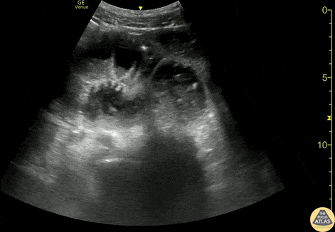 Bowel-GI - Small Bowel Obstruction