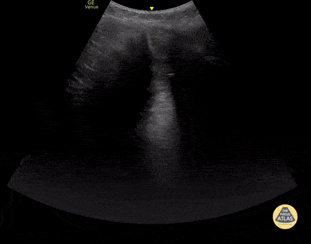 Peds-Biliary - Pericholecystic fluid