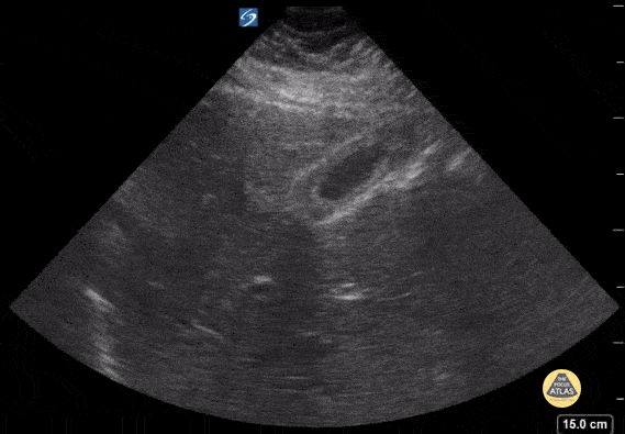 Peds-Biliary - Thick gallbladder wall