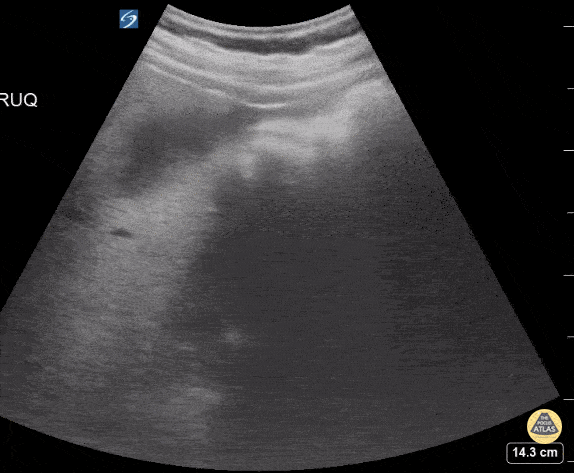 Peds-Biliary - Thickened gallbladder wall with stones