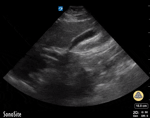 Peds-Biliary - Gallbladder polyp
