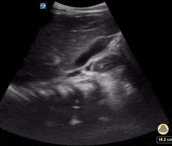 Peds-Biliary - Normal gallbladder