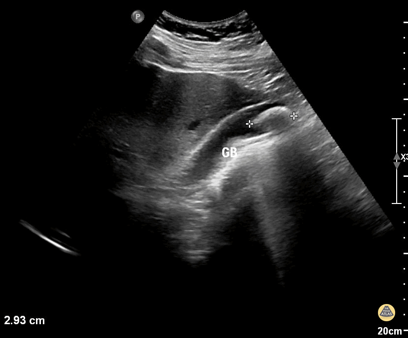 Peds-Biliary - Cholelithiasis