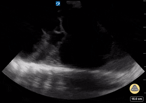 Peds-Lung - Loculated Pleural Effusion