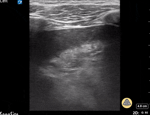 Peds-Lung - 5 Year Old with Pneumonia