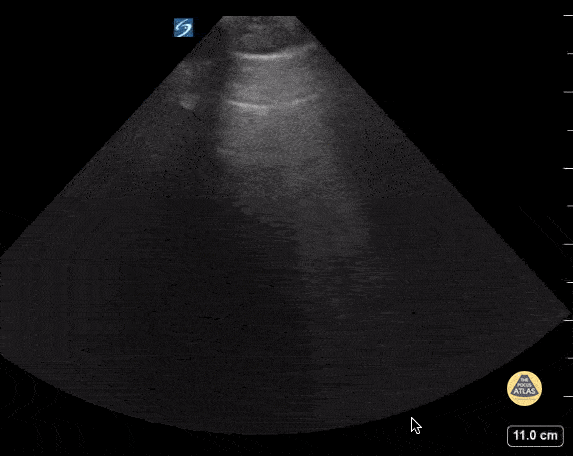Peds-Lung - Pneumonia in a 4 Year Old