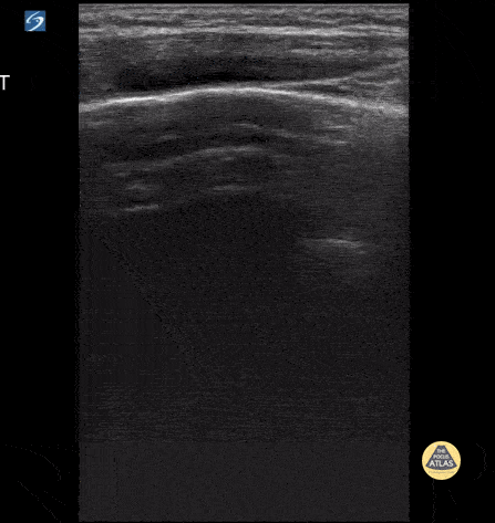 Peds-Lung - Normal Lung Sliding with Comet Tails
