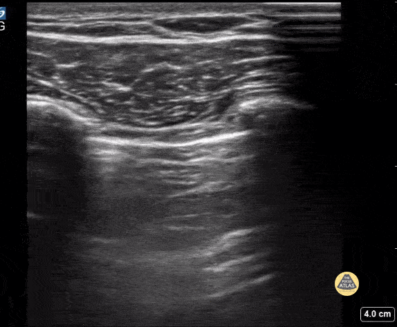 Peds-Lung - No Lung Sliding