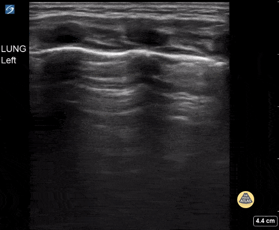 Peds-Lung - Bronchiolitis