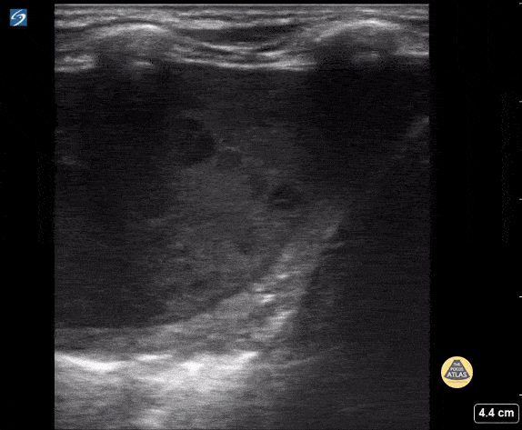 Peds-Lung - Empyema of the Lung