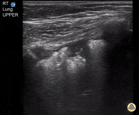 Peds-Lung - Subpleural Consolidation in 3 Year Old