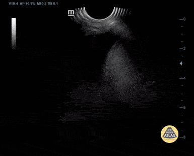 Peds-Lung - Pleural Effusion from Dengue