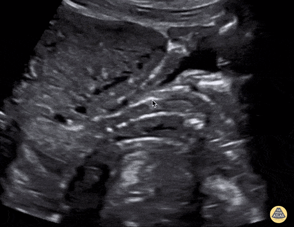OB/Gyn - IUD in Sagittal Plane
