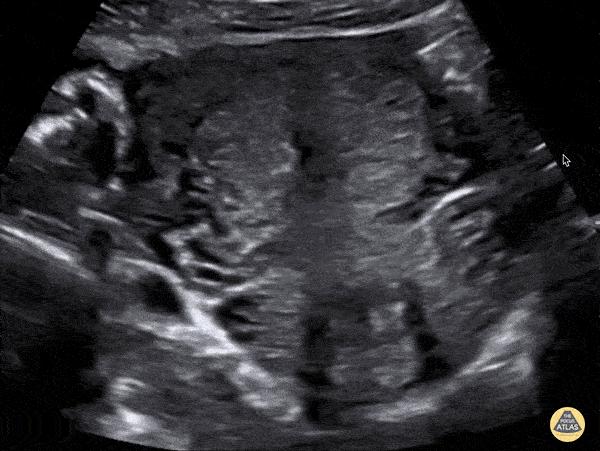 OB/Gyn - IUD in Transverse Plane