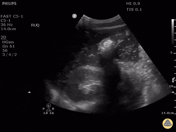 Bowel-GI - Perforated Viscus