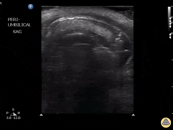 Bowel-GI - Strangulated Hernia With Bowel Necrosis