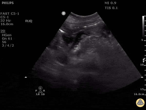 Bowel-GI - Necrotizing Pancreatitis