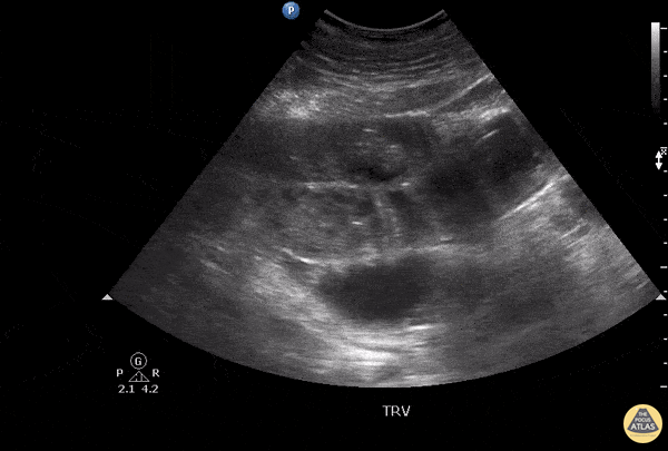 Bowel-GI - Complicated Small Bowel Obstruction