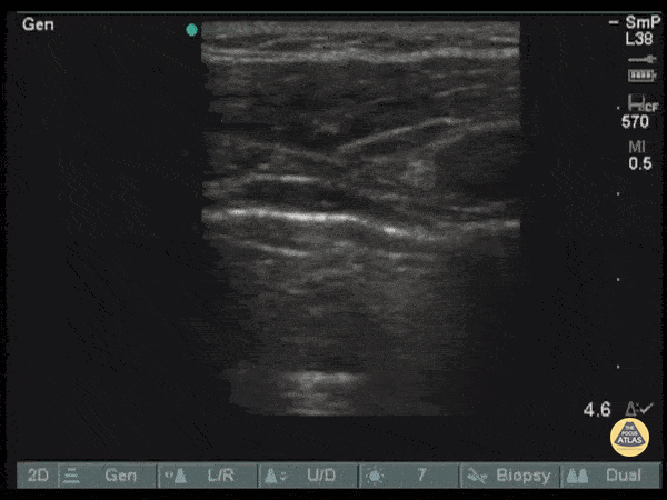 Pulmonary - Lung Re-expansion With Pigtail Catheter