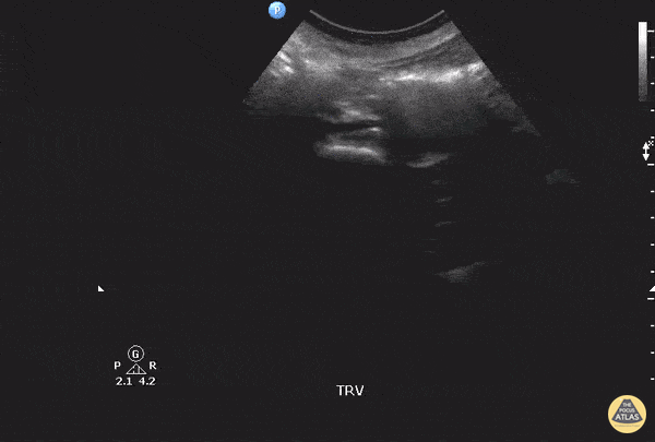 Aorta - Bilateral Iliac Artery Aneurysms