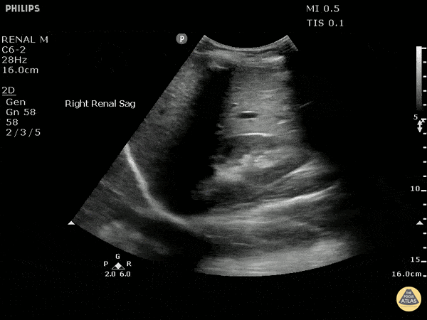 Renal/GU - Renal Cell Carcinoma At Inferior Pole