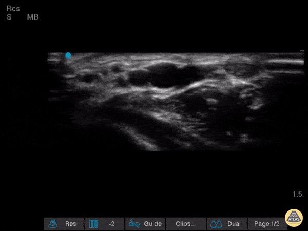 Vascular - Dual Radial Artery