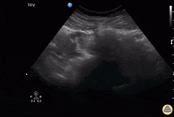 OB/Gyn - Tubal Ectopic Pregnancy