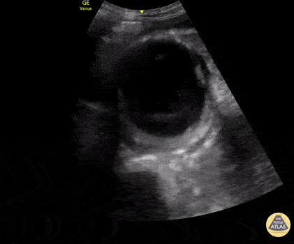 Aorta - AAA in Undifferentiated Shock