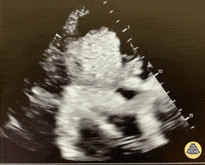 UPLOADS FOR REVIEW - Pericardial Effusion with Tamponade Physiology in the setting of myxedema coma