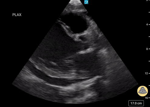 Left Ventricular Dysfunction - New Onset Cardiomyopathy with Reduced Ejection Fraction