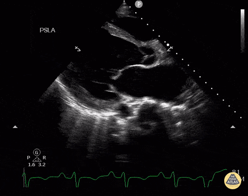 Left Ventricular Dysfunction - Postpartum Cardiomyopathy