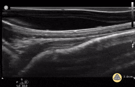 Peds-MSK - Non-displaced parietal skull fracture (Case Series 1/2)
