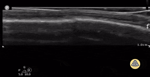 Peds-MSK - Non-displaced parietal skull fracture (Case Series 2/2)