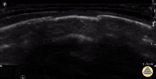Peds-MSK - Depressed parietal skull fracture