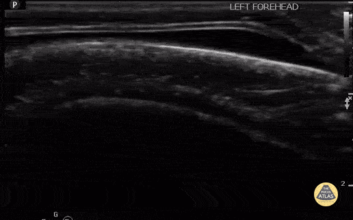 Peds-MSK - Scalp Hematoma