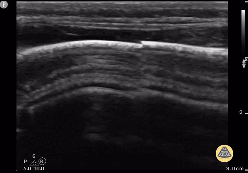 Peds-MSK - Parietal Skull Fracture