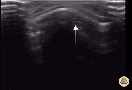 Peds-MSK - Ping Pong Fracture
