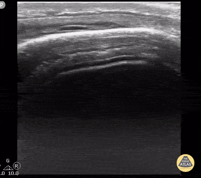 Peds-MSK - Scalp Hematoma