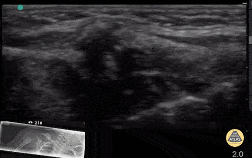 Peds-MSK - Newborn Clavicle Fracture