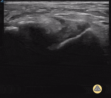 Peds-MSK - Sprained Ankle