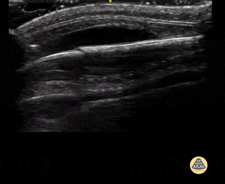 Peds-MSK - Skull Fracture