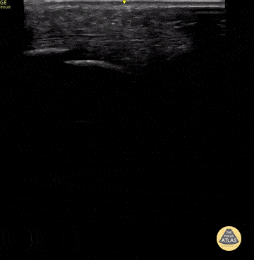 Peds-MSK - Tibia Fracture
