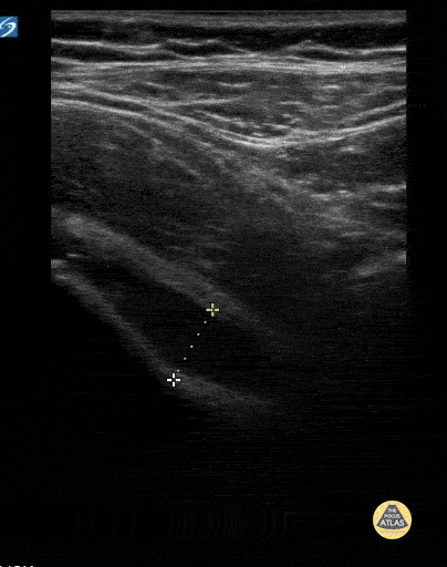 Peds-MSK - Hip Effusion in 6yo 2/2 Transient Synovitis