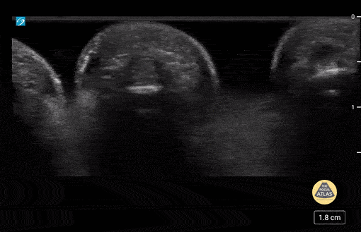 Peds-MSK - Normal Fingers 1 of 2
