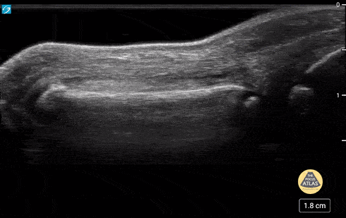 Peds-MSK - Normal Fingers 2 of 2