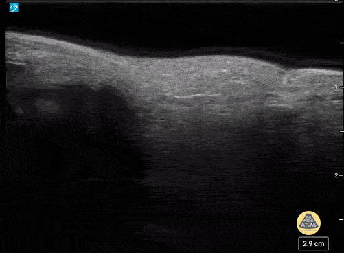 Peds-MSK - Phalanx Fracture Reduction-After