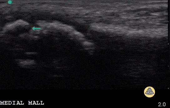 Peds-MSK - Avulsion Fracture