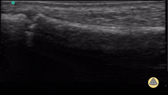 Peds-MSK - Fibula with Normal Physis