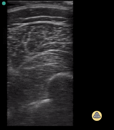 Peds-MSK - Femur Fracture- Case Series, Short Axis