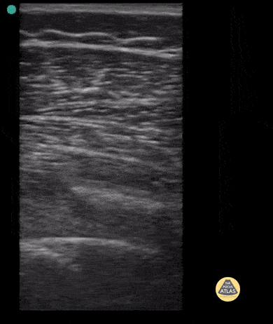 Peds-MSK - Femur Fracture- Case Series, Long Axis
